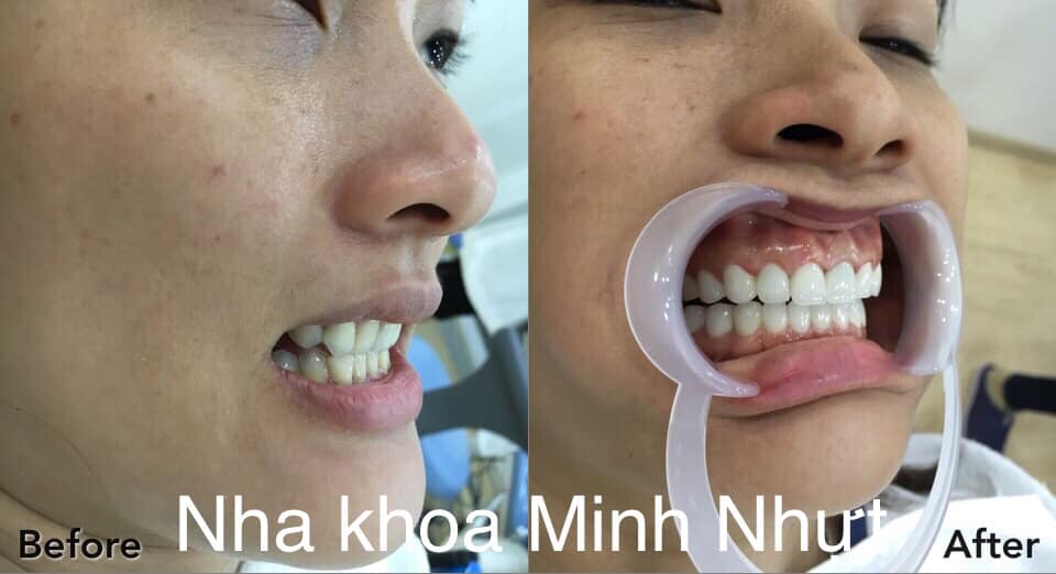 20 đơn vị sứ thẩm mỹ Zirconia