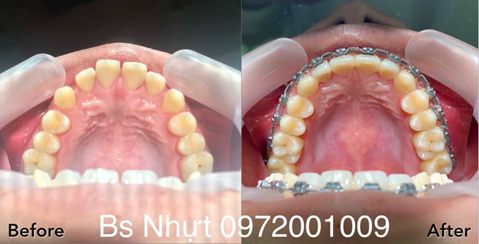 8 Tháng niềng răng Kết hợp cắm 1 implant Kontack