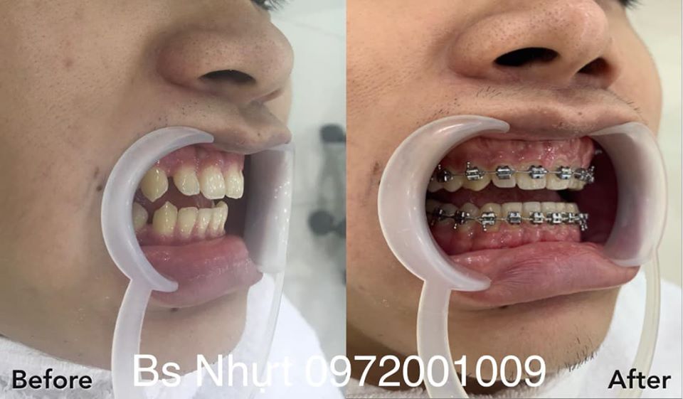 8 Tháng niềng răng Kết hợp cắm 1 implant Kontack