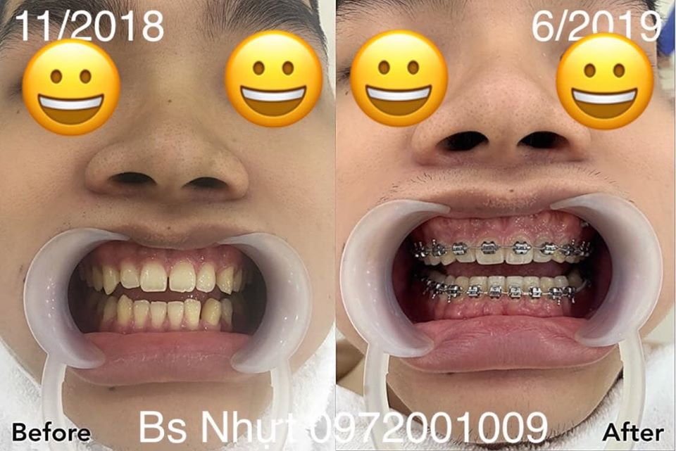 8 Tháng niềng răng Kết hợp cắm 1 implant Kontack