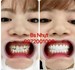 Bọc 16 đơn vị sứ Zirconia