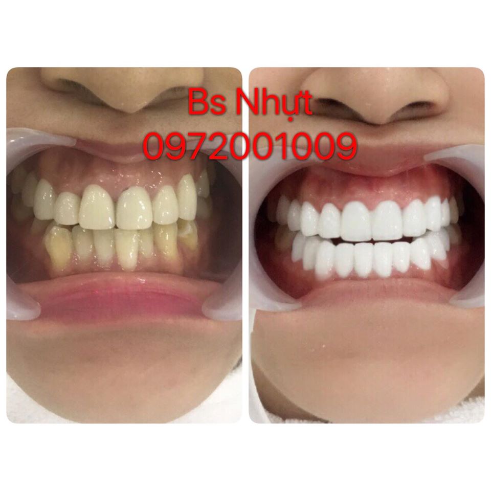 Bọc 19 đơn vị sứ Zirconia