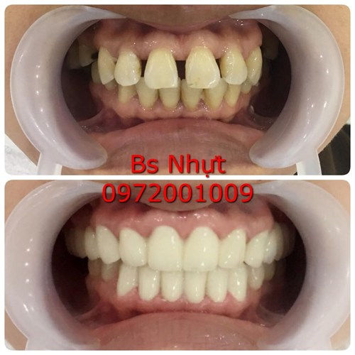 Bọc 20 đơn vị sứ Zirconia