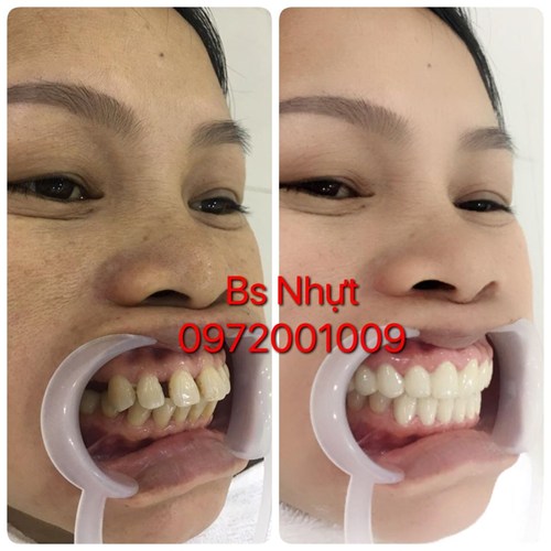 Bọc 20 đơn vị sứ Zirconia