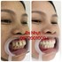 Bọc 20 đơn vị sứ Zirconia