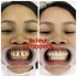 Bọc 20 đơn vị sứ Zirconia
