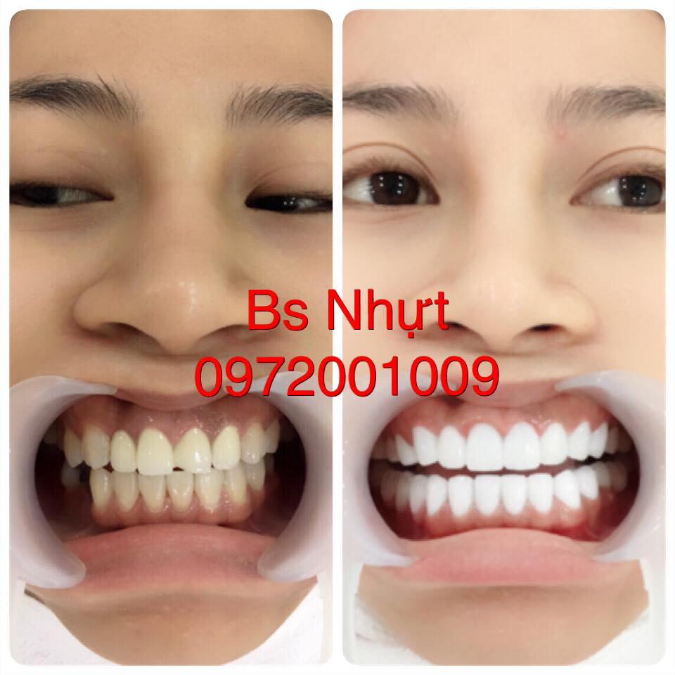 Bọc 24 đơn vị sứ Zirconia
