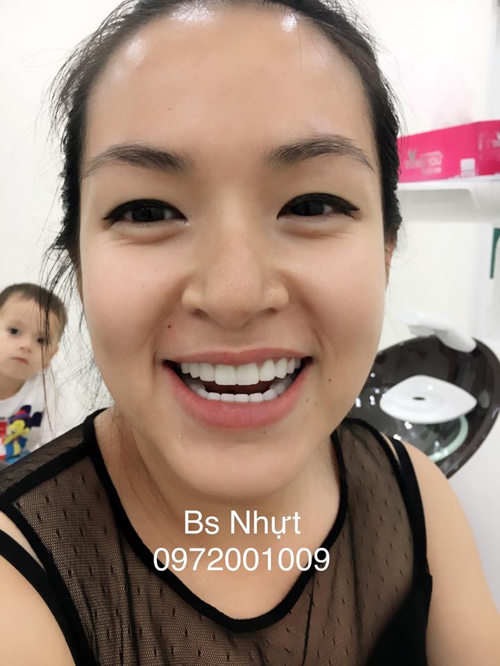 Bọc Răng sứ Lava Plus  3M Espe