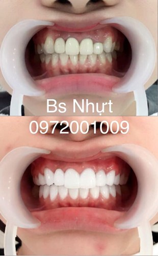 Bọc sứ Zirconia Venus