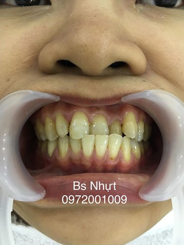 Chỉnh nha cho khách bị khớp cắn ngược 6 tháng