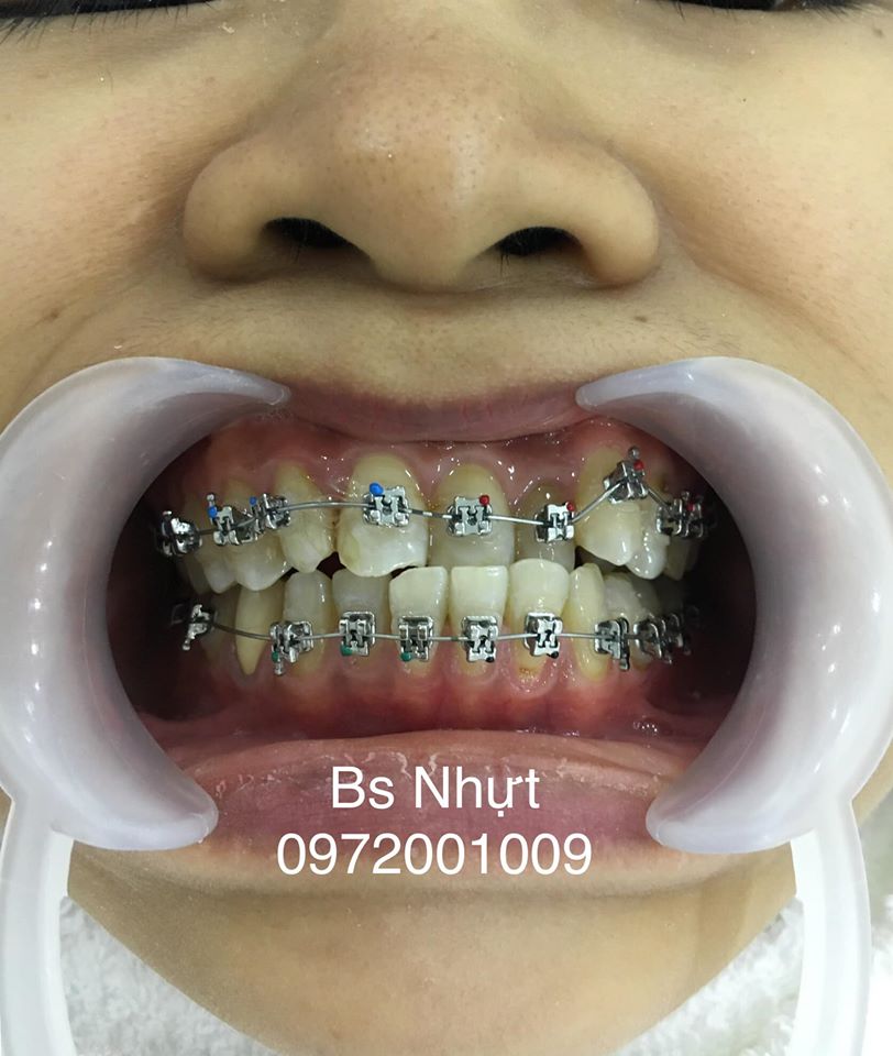 Chỉnh nha cho khách bị khớp cắn ngược 6 tháng