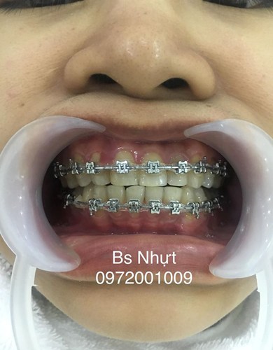 Chỉnh nha cho khách bị khớp cắn ngược 6 tháng