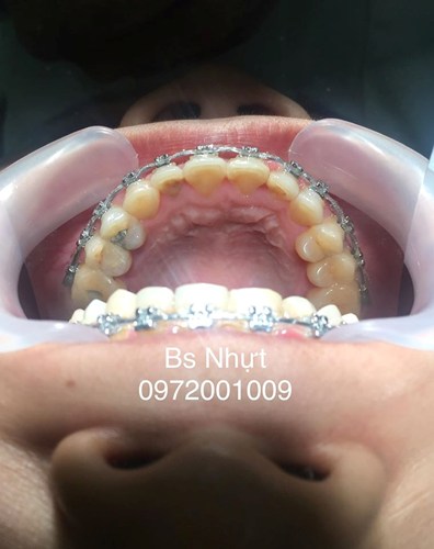 Chỉnh nha cho khách bị khớp cắn ngược 6 tháng
