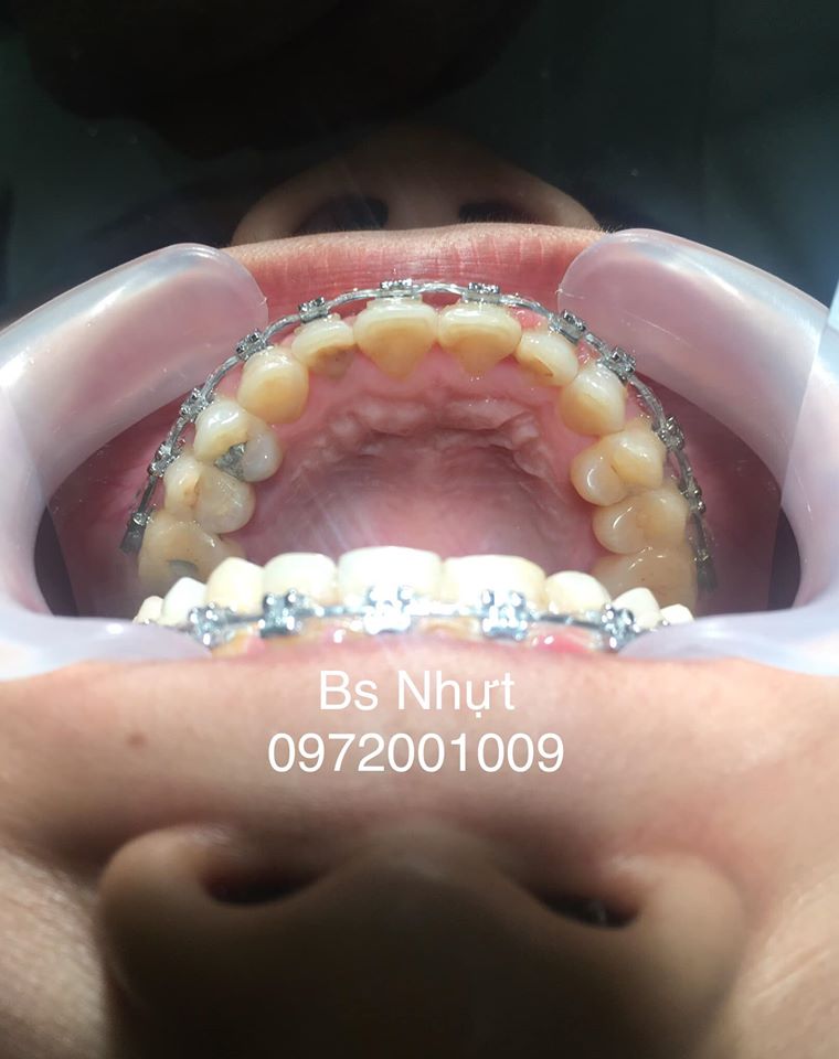 Chỉnh nha cho khách bị khớp cắn ngược 6 tháng
