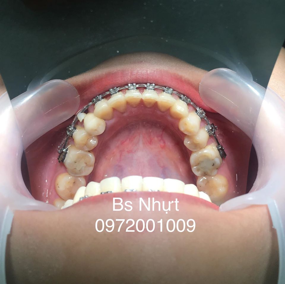 Chỉnh nha cho khách bị khớp cắn ngược 6 tháng