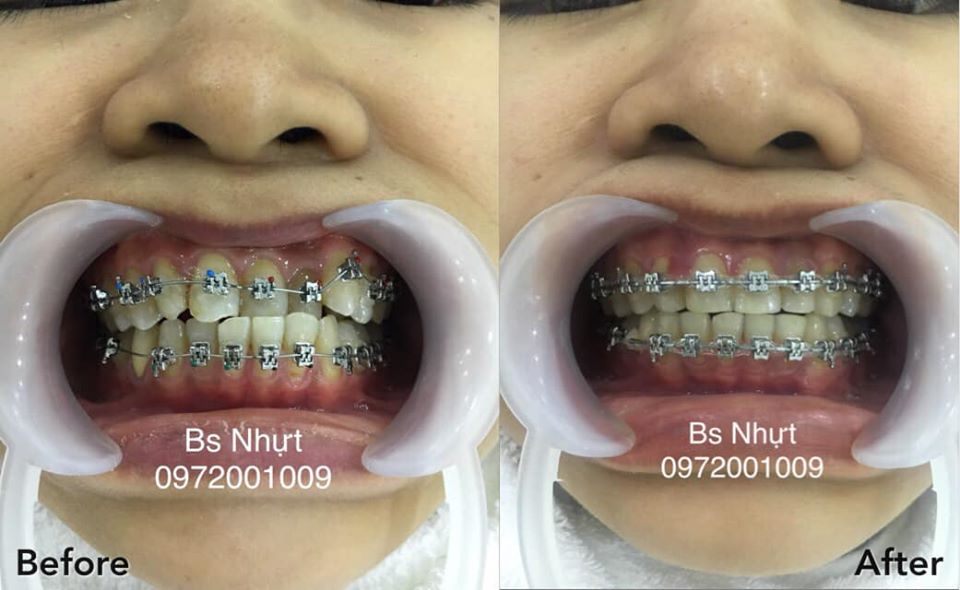 Chỉnh nha cho khách bị khớp cắn ngược 6 tháng