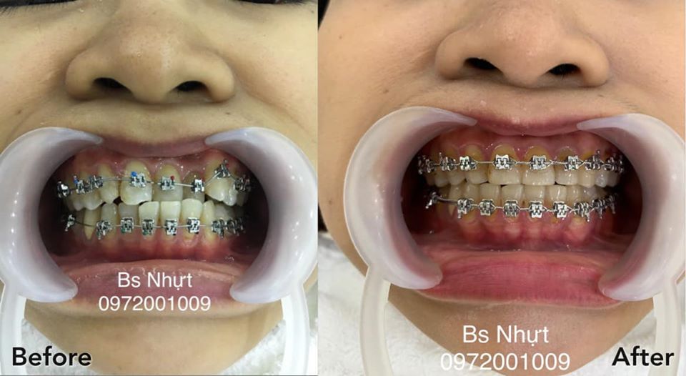 Chỉnh nha khớp cắn ngược