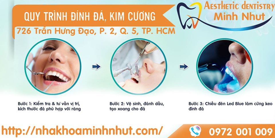 Đính đá đính kim cương tại Nha khoa Minh Nhựt