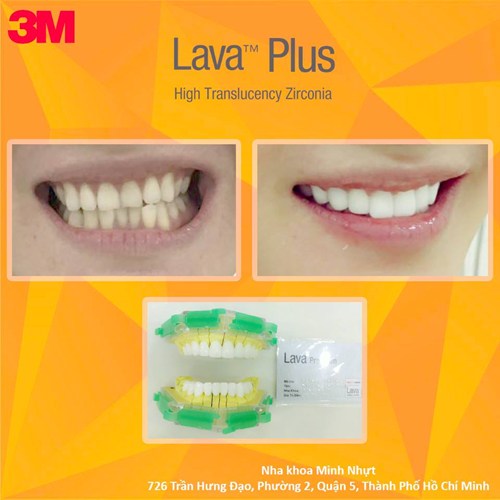 Nụ cười tỏa sáng với Lava Plus