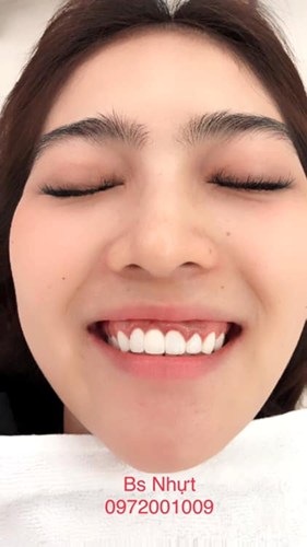Thẩm mỹ toàn sứ kết hợp cắt nướu điều trị cười hở nướu dứt điểm