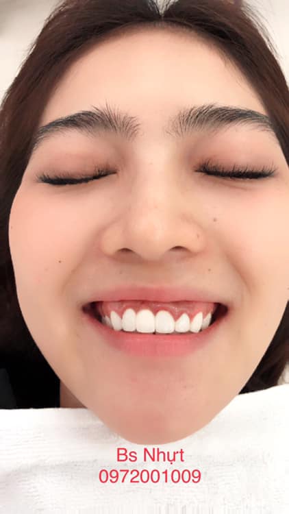 Thẩm mỹ toàn sứ kết hợp cắt nướu điều trị cười hở nướu dứt điểm